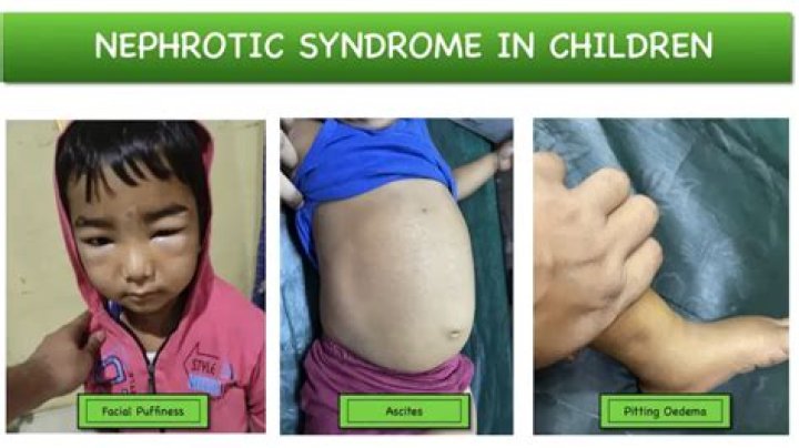 
What Is Wrong With Caito Potatoe? The YouTuber Is Suffering From Nephrotic Syndrome 